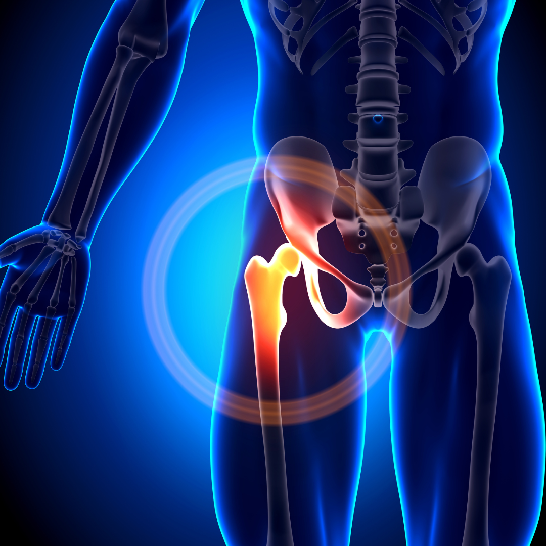 Hip Replacement: An Overview and Why India is a Leading Destination